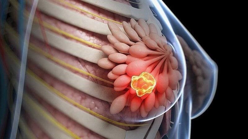 Tôi đi khám tuyến vú chỉ vì muốn yên tâm, nhưng không ngờ phát hiện u từ rất sớm