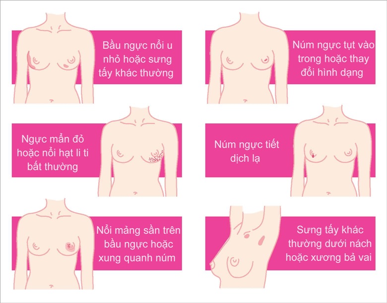 Tự khám tuyến vú tại nhà đúng cách để phát hiện sớm u và bất thường