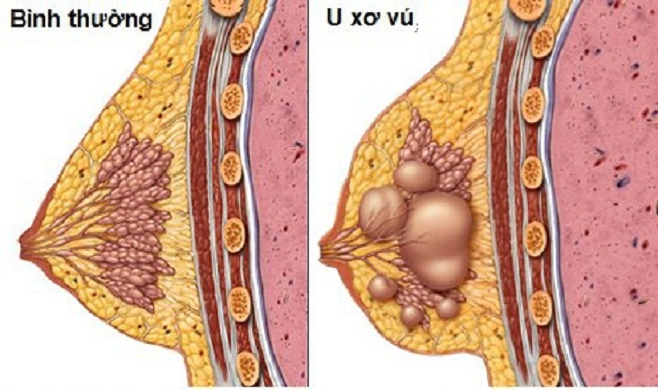 U xơ vú: Những điều bạn cần biết về dấu hiệu và phương pháp điều trị