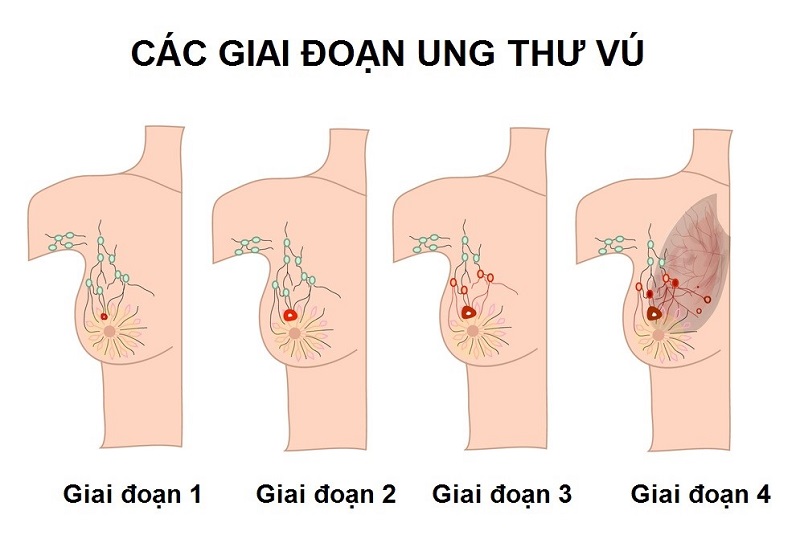 Các Giai Đoạn Ung Thư Vú Phụ Nữ Nhất Định Phải Biết
