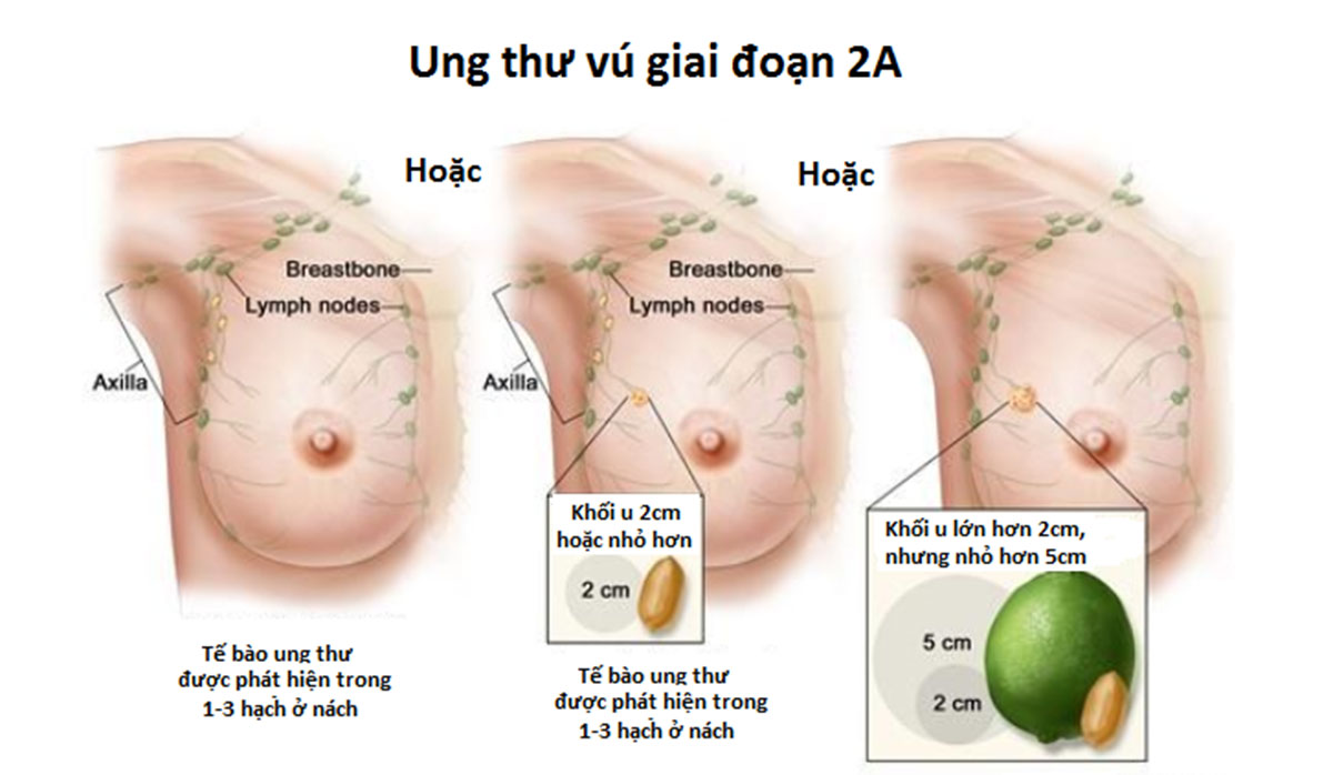 Ung thư vú giai đoạn 2: Triệu chứng, điều trị và cơ hội sống sót
